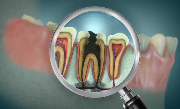 Preserve Your Tooth and Prevent Future Dental Problems Root Canal Treatment in Islamabad Pakistan: