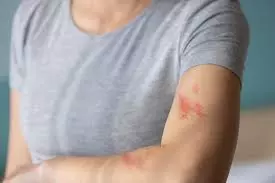 Bacterial Infection vs Fungal Infection