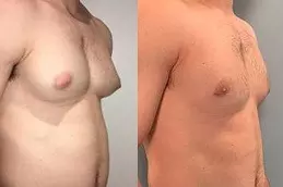 Gynecomastia Surgery Cost Tips Every Man Should Know