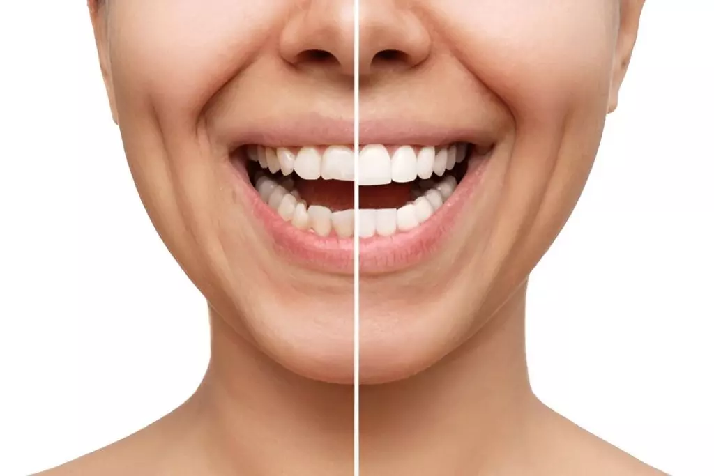 Crooked Teeth Treatment for Different Types of Misalignment