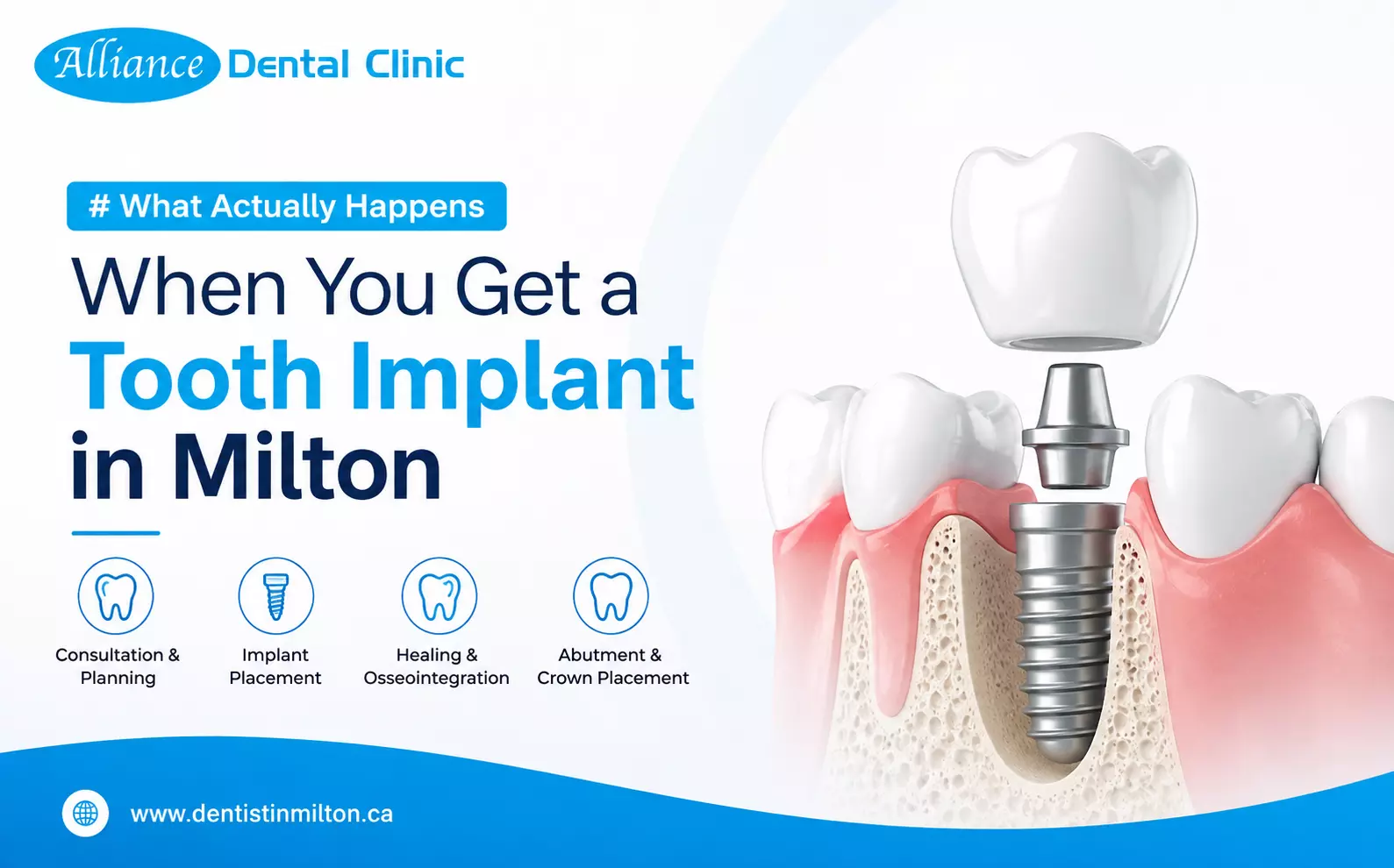 What Actually Happens When You Get a Tooth Implant in Milton