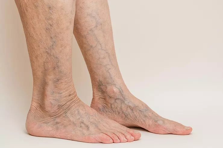 How Diet Can Help Manage Venous Insufficiency?