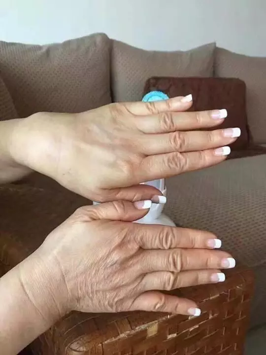 Turn Back the Clock with Youthful Hands: Hand Rejuvenation in Islamabad