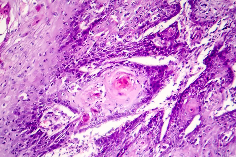 Advancing Antiviral Drug Development Through Varicella-Zoster Virus Research Samples