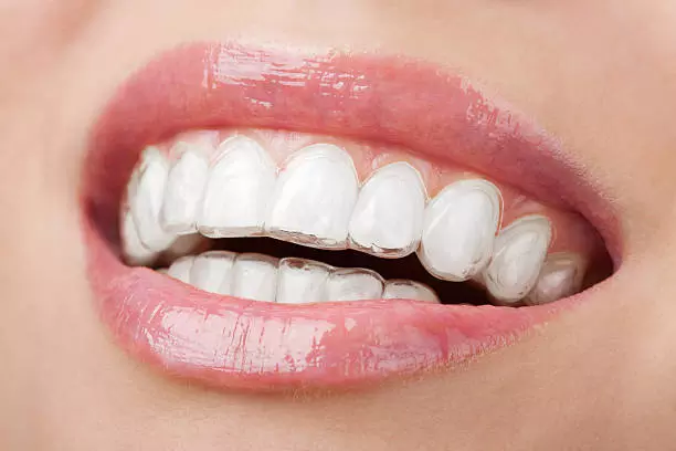 Secure Your Perfect Smile with Teeth Retainers in Islamabad