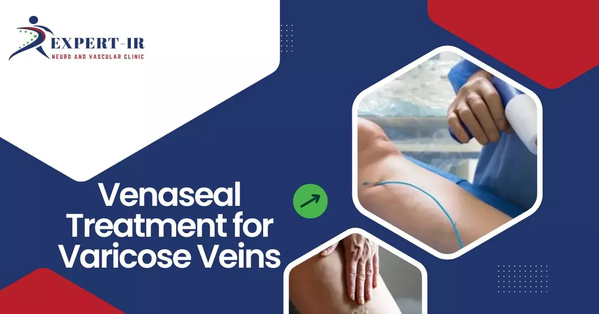 Venaseal Treatment for Varicose Veins – A Modern, Painless Solution for Long-Lasting Relief