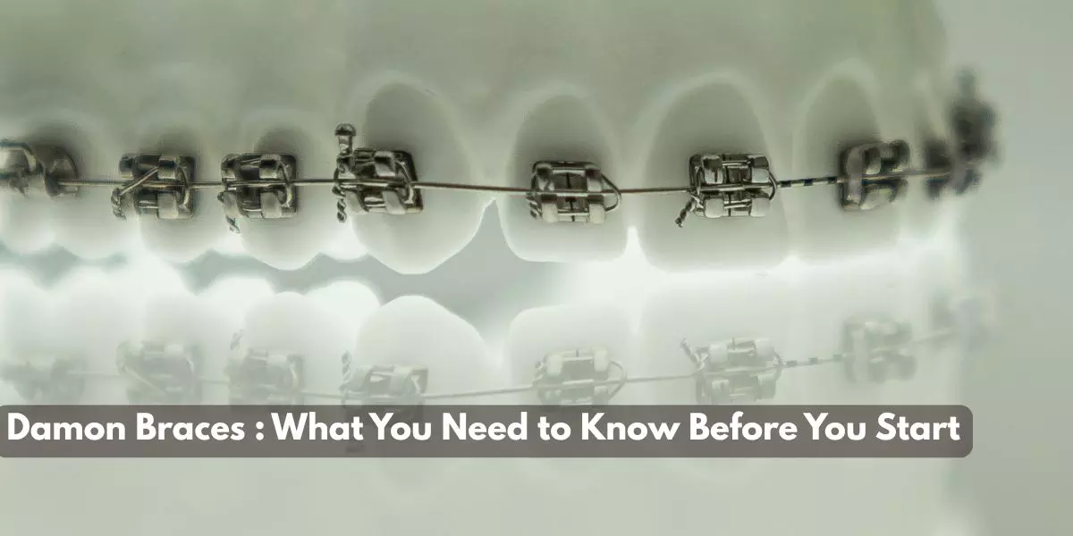 Damon Braces : What You Need to Know Before You Start