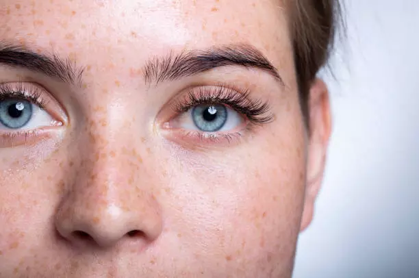 Eyelash Hair Transplant in Dubai for People With Glasses