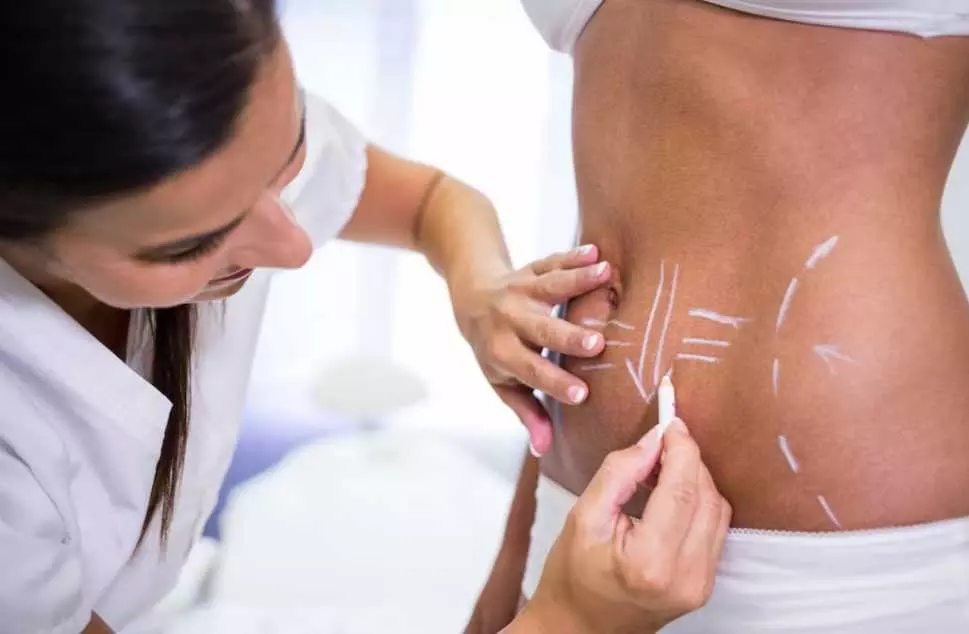 Liposuction Results in Islamabad: How Long Do They Last?