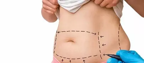 Liposuction Surgery in Islamabad: A Solution for Stubborn Fat
