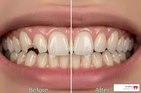 Elevate Your Everyday Smile with Dental Bonding