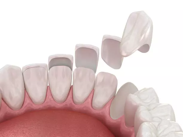 A Trusted Way to Achieve a Perfect Smile Dental Veneers in Pakistan: