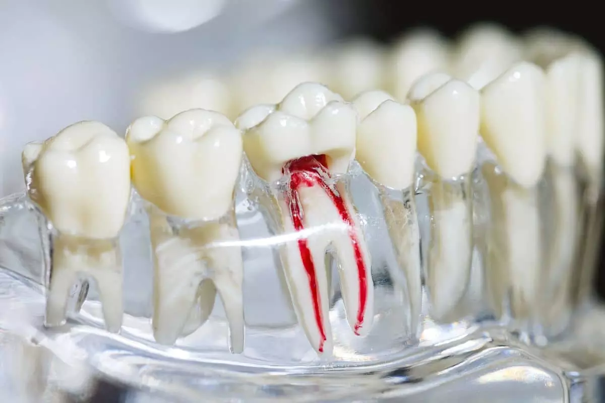 Root Canal Treatment: How Tooth Decay Leads to It