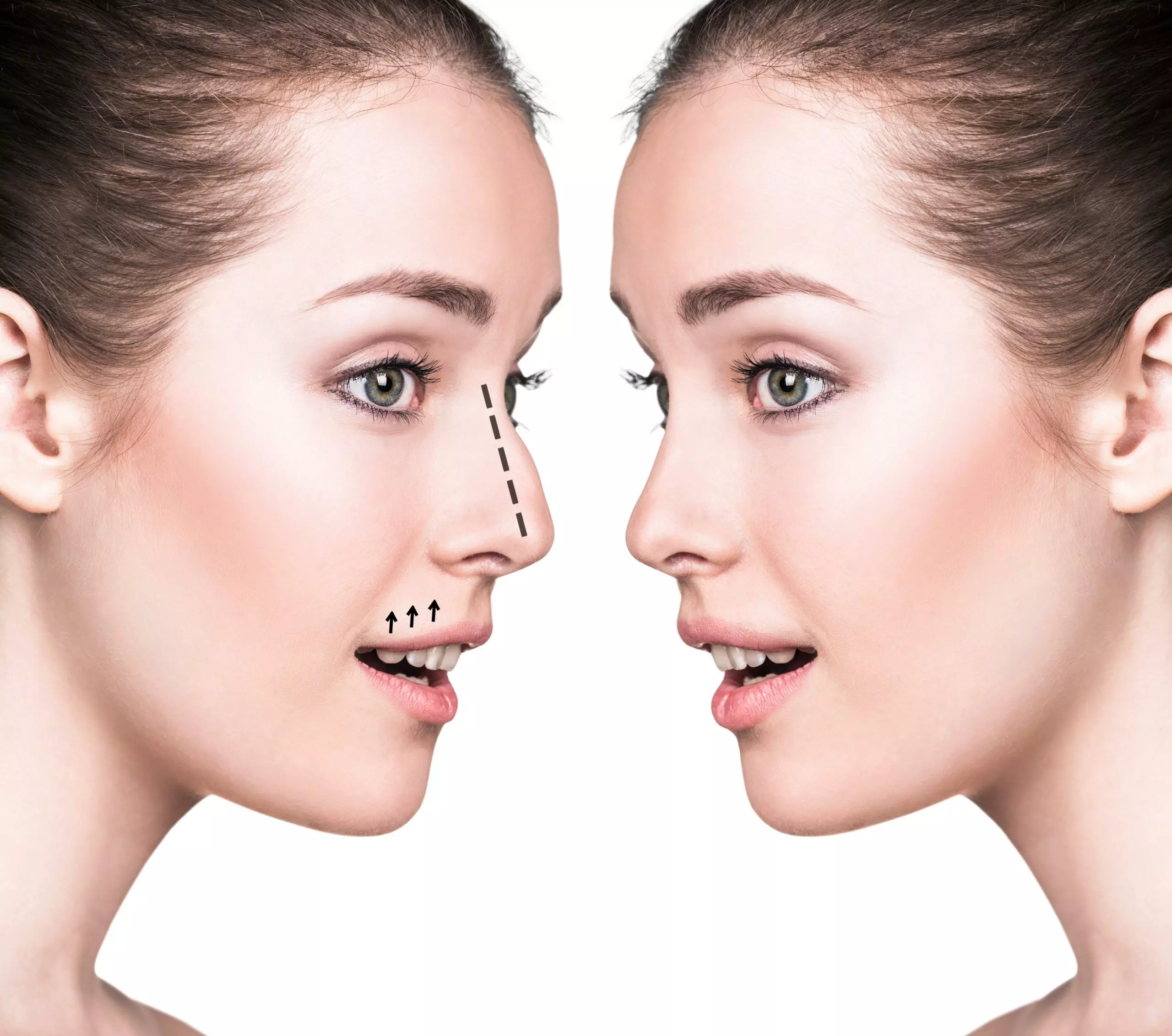 Is Rhinoplasty Suitable for Teenagers or Young Adults?