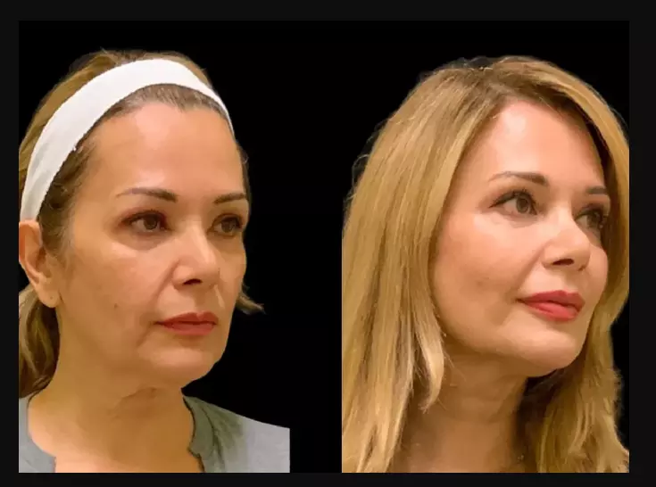 Why Sculptra Fillers Treatments in Dubai Are the Future of Non-Surgical Aesthetics