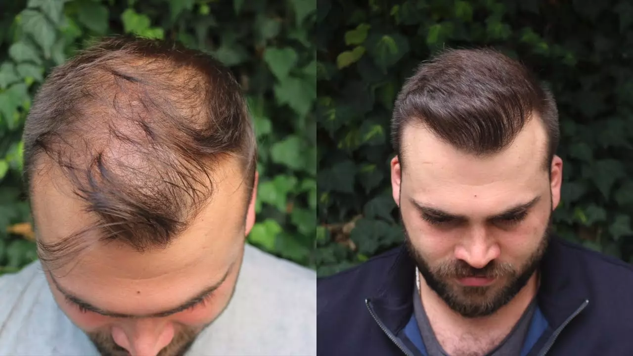 Is paying more upfront for hair transplant in Dubai cheaper in the long run?