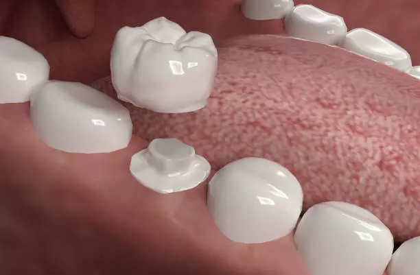 Dental Crowns and Their Role in Restoring Healthy, Functional Smiles