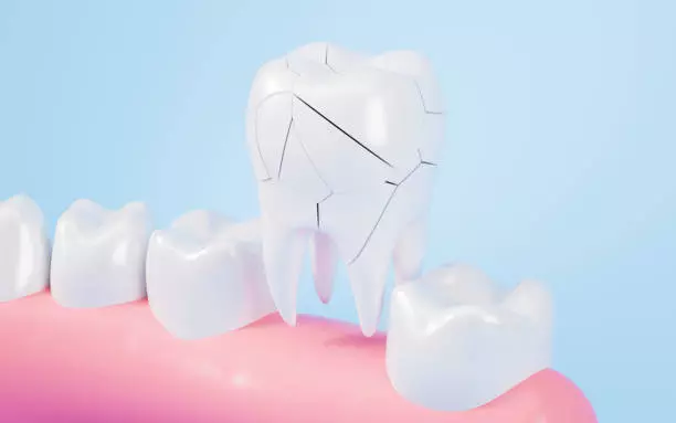Common Myths and Facts About Tooth Fractures in Pakistan