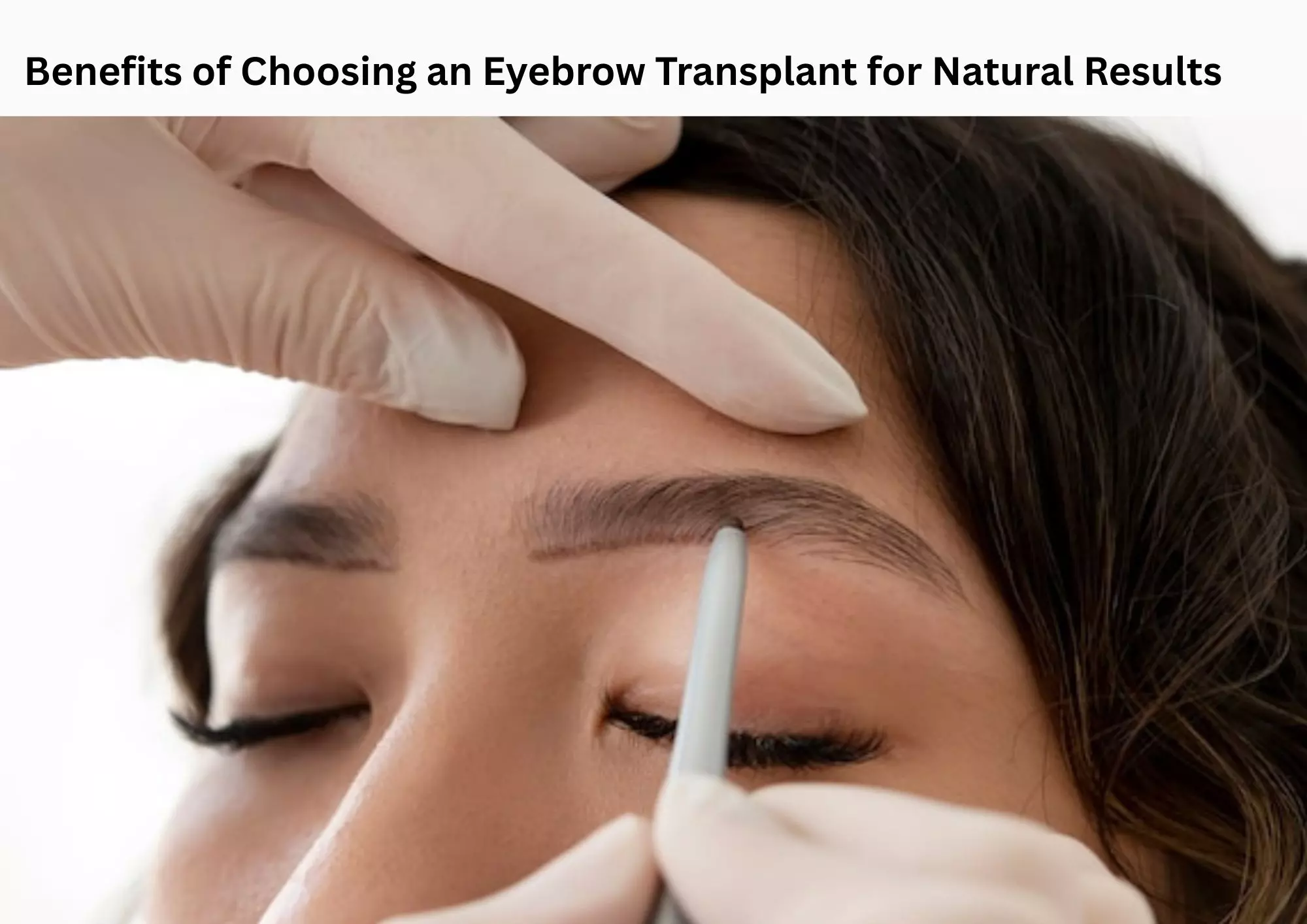 Benefits of Choosing an Eyebrow Transplant for Natural Results