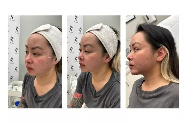 Youth Unveiling the Magic of 7D HIFU Facial Treatment