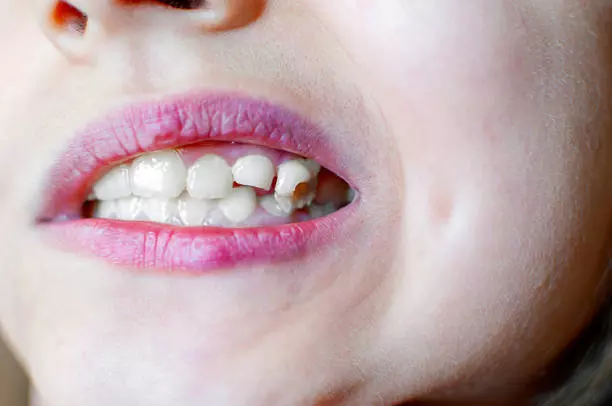 Complete Overview of Tooth Fracture Treatment in Islamabad for Lasting Results