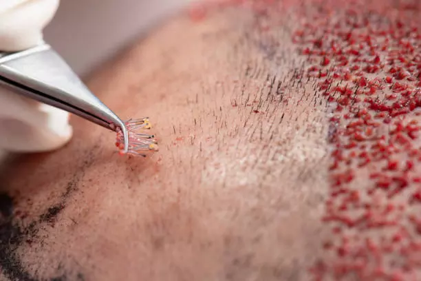 DHI Direct Hair Implant in Dubai for Widening Part Lines