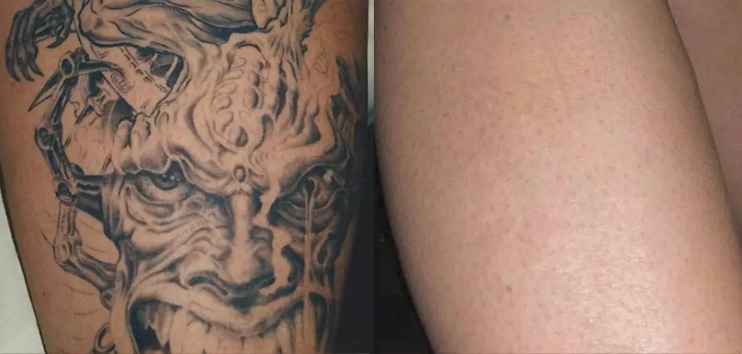 Choosing the Right Tattoo Removal Clinic: Factors to Consider