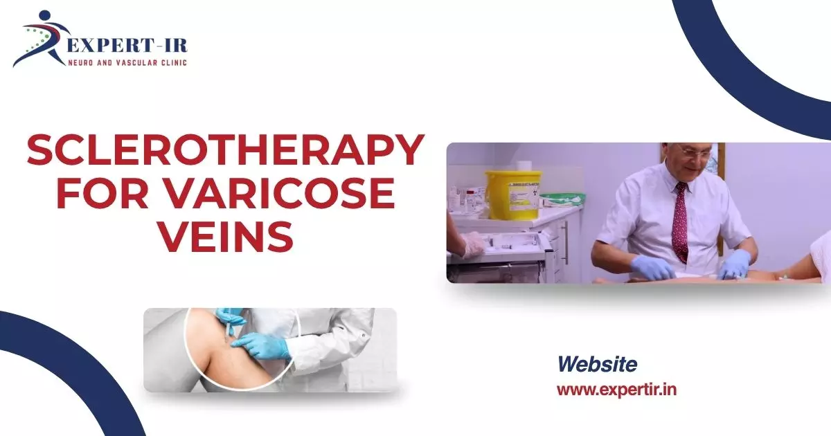 Sclerotherapy for Varicose Veins: Interventional Radiologists in Pune