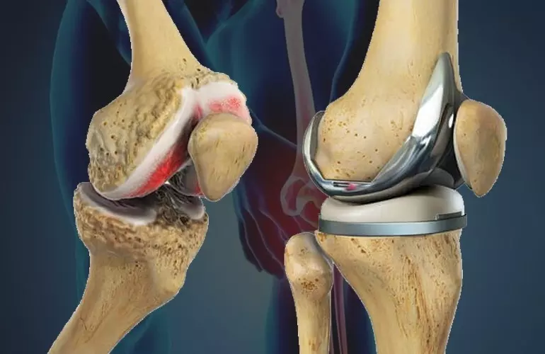 Joint Replacement in India: Advanced Implant Materials and Their Impact