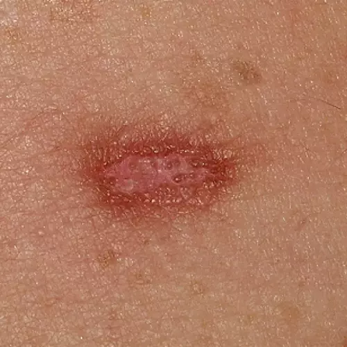 What is Dermatofibroma? Guide to Symptoms, Causes & Care