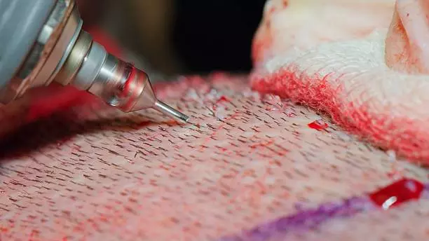 FUE Hair Transplant in Islamabad – Achieve Natural Hair Growth