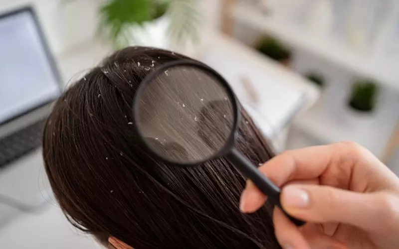 Winter Scalp Woes? Say Goodbye to Dandruff with These Shampoos