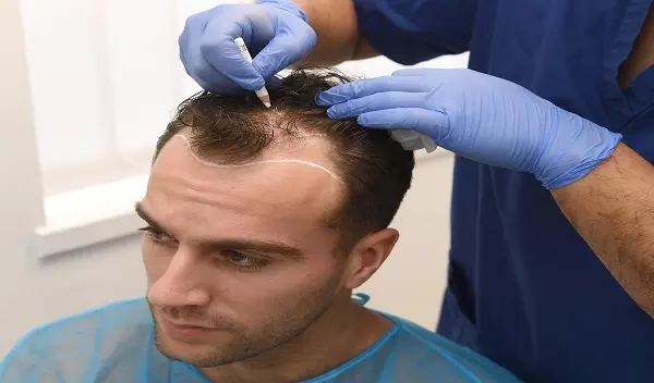 What is a Hair Transplant? A Beginner’s Guide in Islamabad