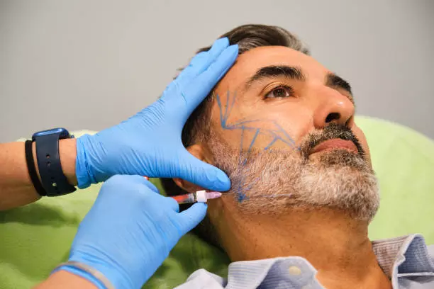 A Complete Transformation for Your Facial Style Beard Hair Transplant: