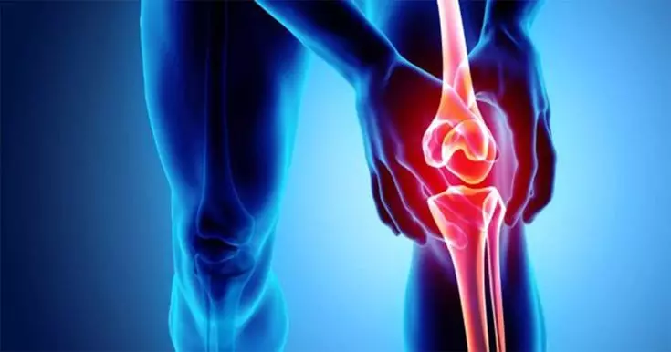 Arthrosamid for Knee Pain: A Realistic Option for People Tired of “Just Managing It”