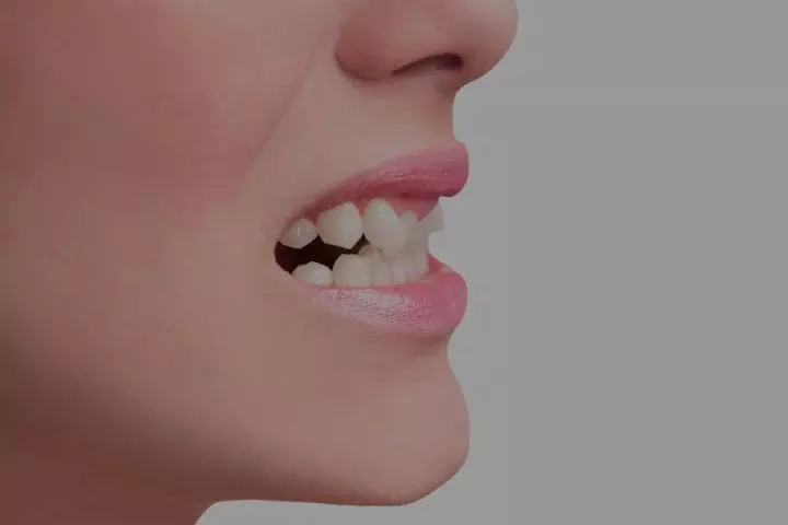 Crooked Teeth Treatment for People with Sensitive Teeth