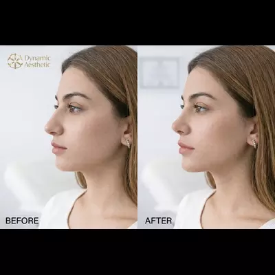 What Makes Rhinoplasty in Islamabad a Top Choice for Pakistanis