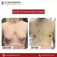 Gynecomastia vs Chest Fat: How to Tell the Difference & Choose the Right Treatment