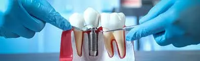 Top Dental Implant Benefits for a Confident Smile